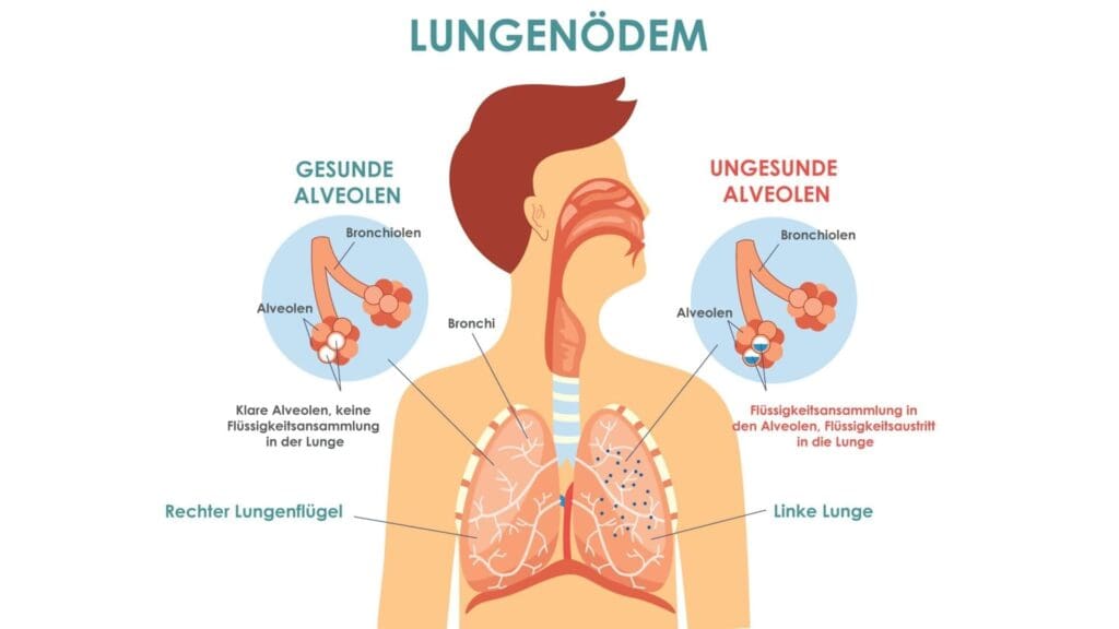 pulomnary odema de Eakin Healthcare