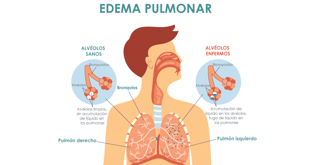 una ilustración que muestra los alvéolos sanos frente a los alvéolos no sanos en pulmones llenos de líquido