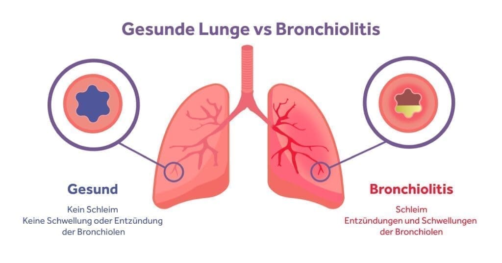 INSPIRE Behandlung von Bronchiolitis 1 Eakin Healthcare