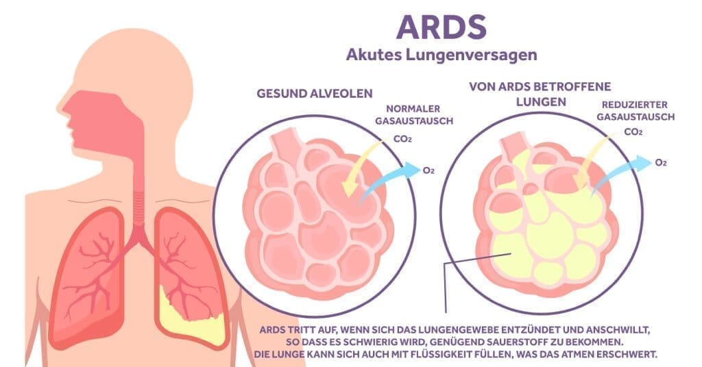 INSPIRE Der Leitfaden fur Intensivpflegepraktiker zu ARDS Merkmale und Behandlung Header Eakin Healthcare
