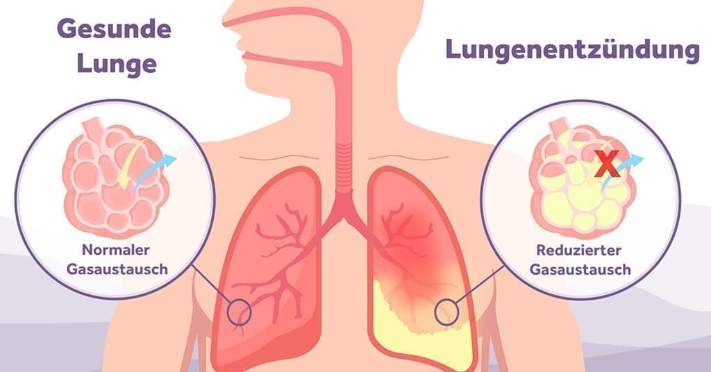 INSPIRE Intraventricular Haemorrhage in Preterm Infants Pathophysiology Risk Factors and Management DE Eakin Healthcare